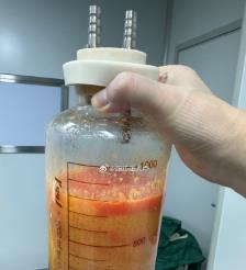 南漳水动力吸脂手术要做多久？